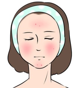 にきびの進行度を確認