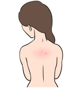 背中にできたニキビ
